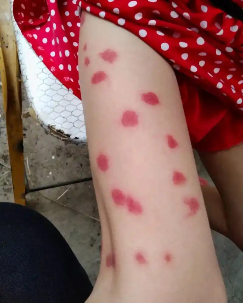 有蚊子咬到我了,我把她裤子脱下一看起了一腿的红疙瘩,赶紧给她洗了又