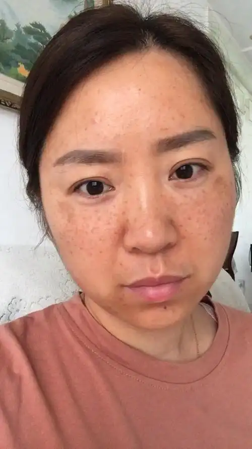 八年婚姻,六年的麻子脸,两个月的改变,感谢你当年的嫌弃之恩.