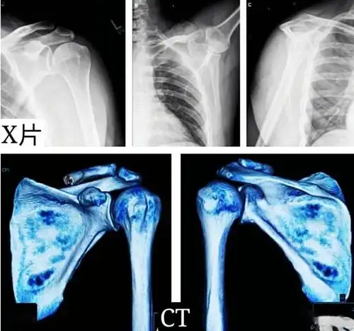 这种最容易被忽视的肩背疼痛,你真的读懂了吗?_肩胛