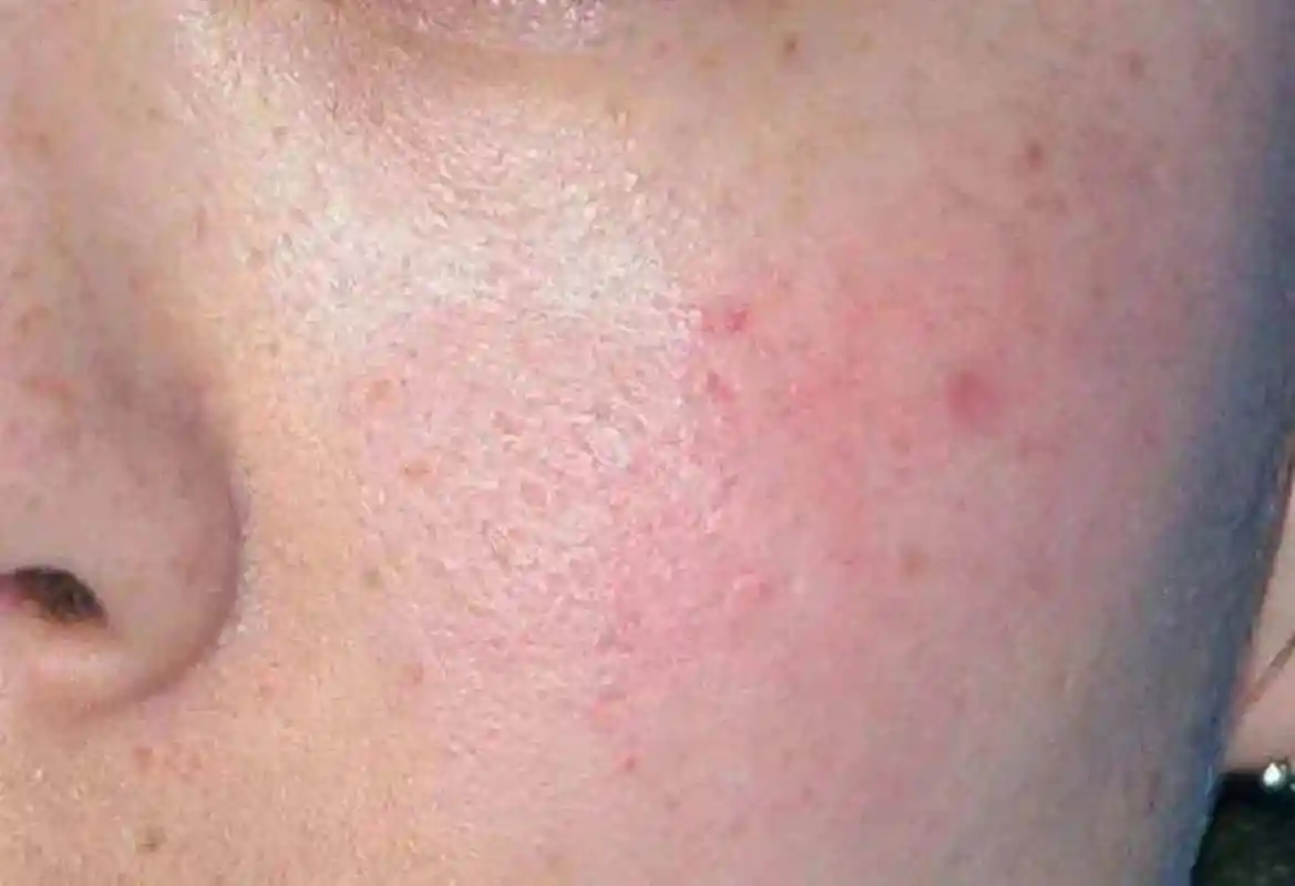 过敏# #皮肤屏障受损##泉州皮肤科医院#  敷面膜脸上刺痛有灼烧感