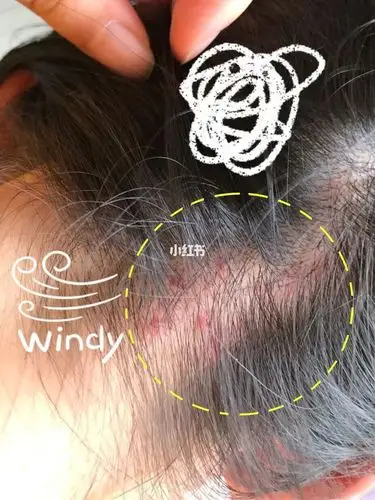 毛囊炎长九个包的就只有我了吧