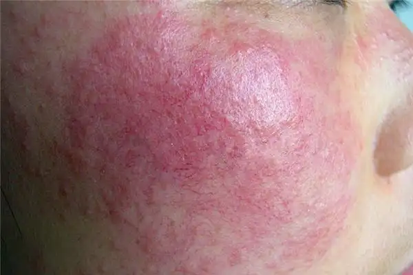 是指人体接触到某些过敏源而引起皮肤红肿,发痒,风团,脱皮等皮肤病症