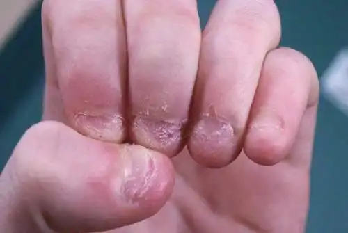 宝宝啃指甲是怎么回事两岁宝宝啃指甲是怎么回事