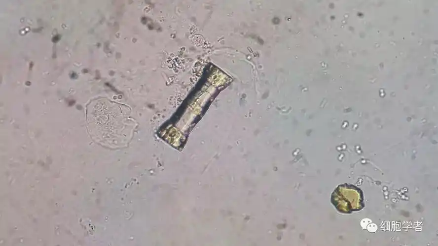 尿酸结晶的形态