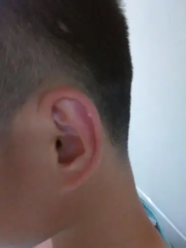 耳朵上耳廓处长了一个白色的包,不痛不痒,请问是什么?