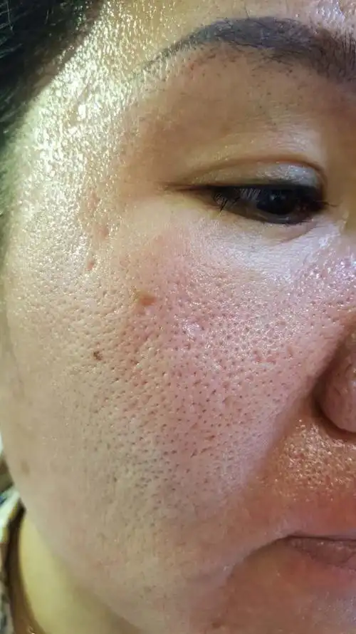 润妮秀钻石面膜改善毛孔粗大的肌肤