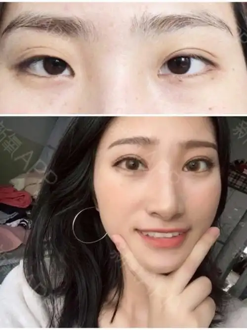 这次本来还想做埋线的,但是师院说自己的眼皮比较松弛,切开的效果会更