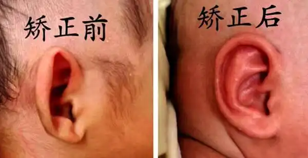 新生儿耳廓畸形临汾市妇幼保健院可实施无创矫正