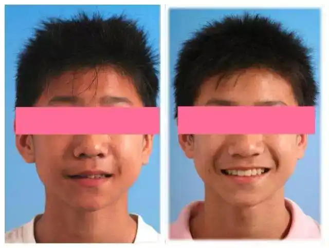 尖牙vs虎牙 这次我pick这颗长得壮又能吃的牙_儿童牙病_疾病介绍_相关