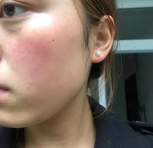 脸颊有红血丝脸上有红血丝是敏感肌吗