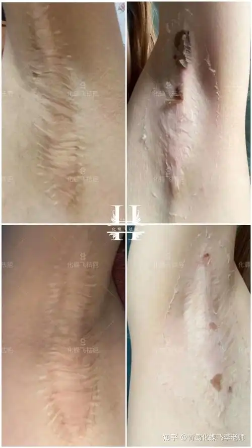 9年多的腋下手术疤痕修复