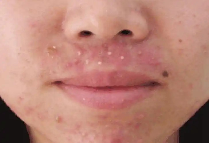 阴茎长毛囊炎的症状图片