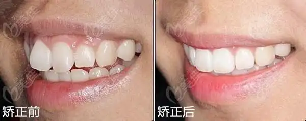 隐适美牙套矫正前和后