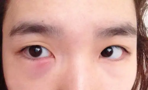 下眼皮突然红肿而且很疼 眼皮内也充血 按下去发硬 睁着眼睛还发酸 之