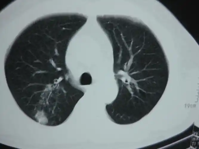 肺结核球_肺结核结核球-万县网