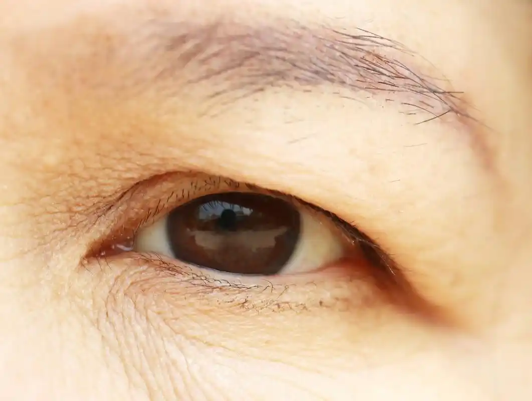 眼睑下垂图片  眼睑下垂是一种常见的眼部疾病,是指上眼睑无法完全