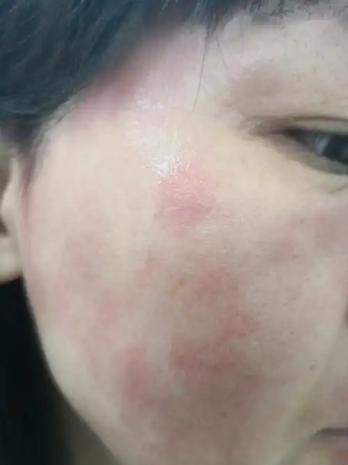 解决皮肤问题专注皮肤美容##使用化妆品过敏的这么多是为什么?