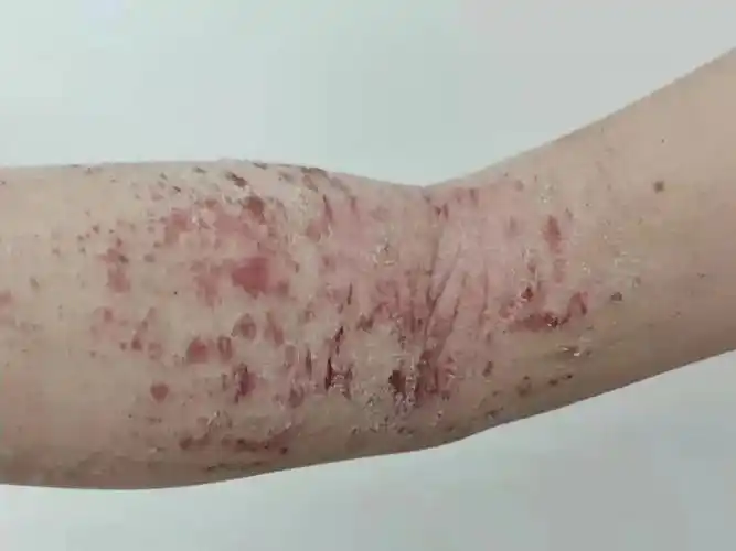 一个12岁女孩的皮肤粗糙得像块老树皮, 背上,手肘窝上全是新旧伤口.