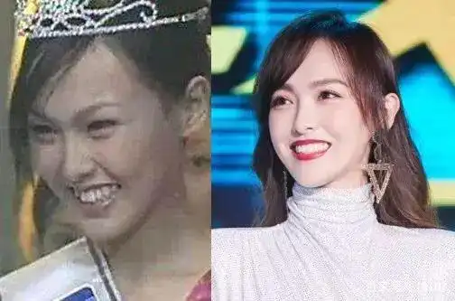 盘点明星牙齿整形大变样,整牙堪比整容换脸