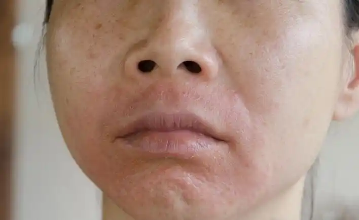 冬天肌肤屏障受损严重?亲美人支招帮你修护-珂珂说护肤