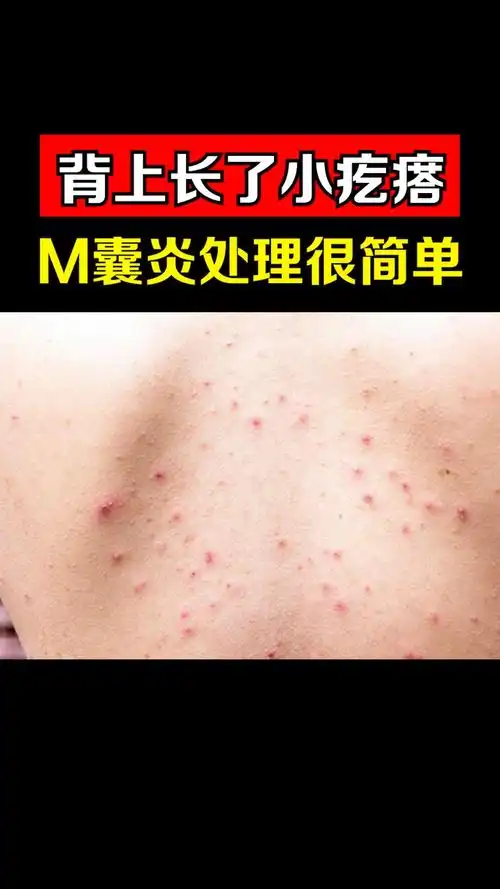 南方健康背上长了小疙瘩毛囊炎处理很简单