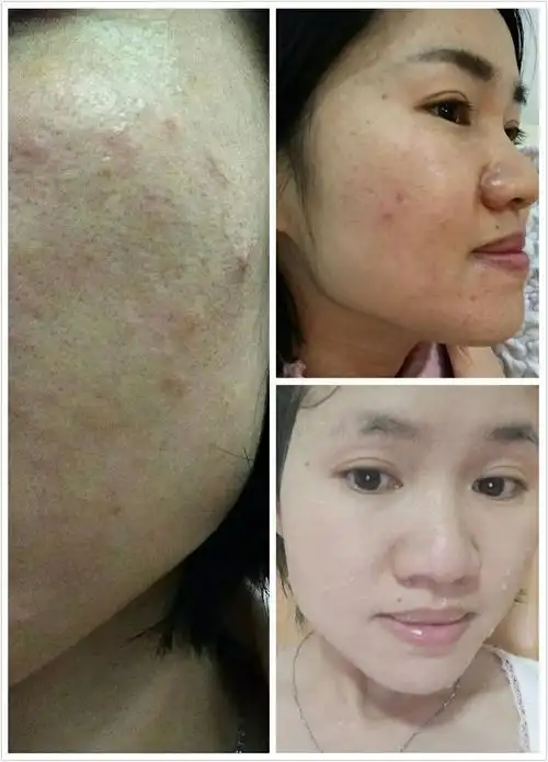 长了十二年的痘痘,终于给灭了