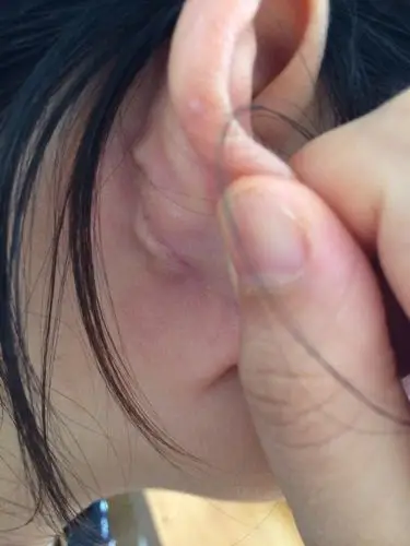 问:我耳朵怎么了?有两个硬的痘痘有点痛