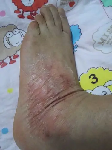 我母亲的脚面这两年表皮里面长水泡,特别痒,去两次医院医生说是湿疹
