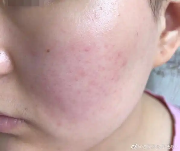 面部皮肤敏感发烫长红斑起小疹子-痤疮图片