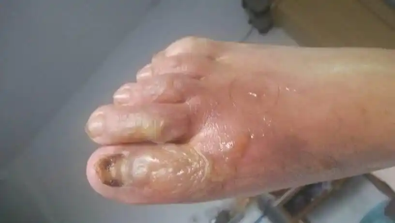 脚背浅二度烫伤4%,得多长时间能走路