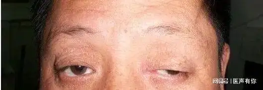 反复疲劳眼睛睁不开警惕重症肌无力缠上你