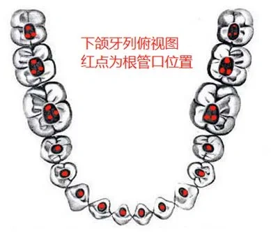 根管治疗的标准流程!