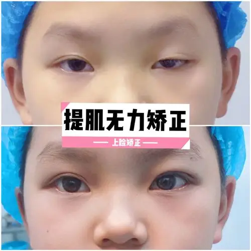 恐怕是史上年纪最小的提肌无力矫正了叭