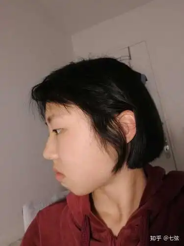 不笑的时候下巴有一块肉嘟起来,从小就有,很困扰,请问有何建议?(有图)