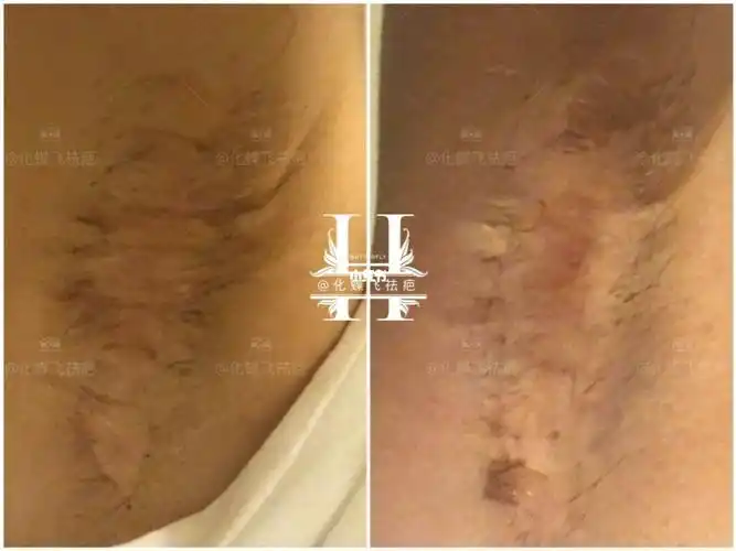 腋下疤痕_疤痕_疤痕修复_手术疤_美女_腋下疤痕_医疗健康_医疗健康