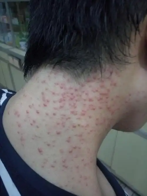 马拉色菌毛囊炎