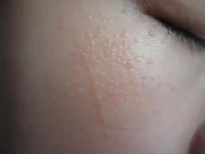 扁平疣面部初期图片