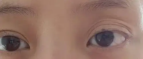 唐红军医生科普上眼睑下垂和上眼睑松弛的区别在哪里