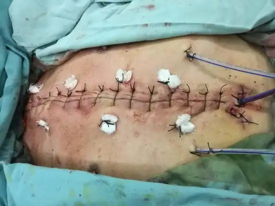 胸骨哆开伴纵隔摆动