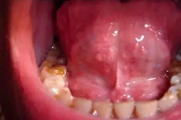 一旦患上了此病该怎么办)