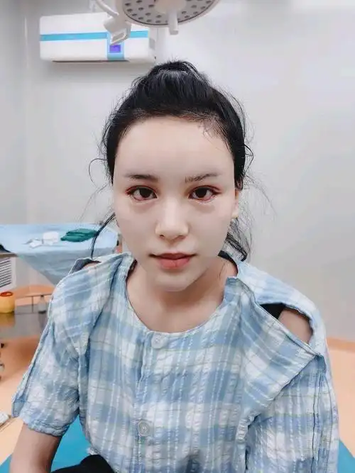 下眼睑下至和开外眼角做了四个多月了,感觉自己的眼睛_圈子-新氧美容