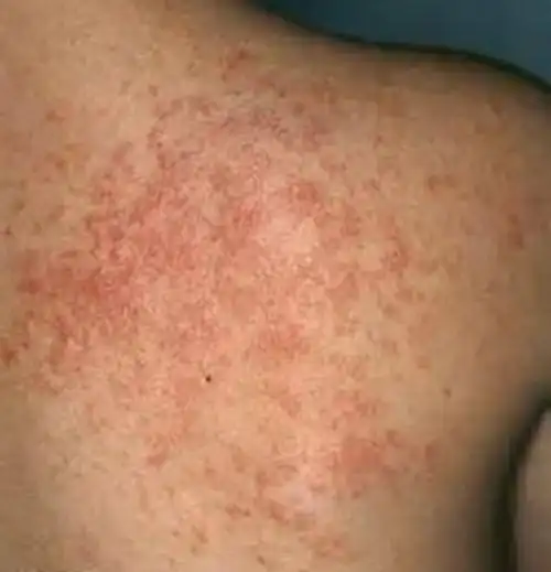 男性成人背部痱子图片