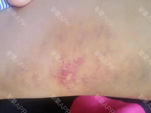 大腿里面淤青……——这是怎么回事(_)啊