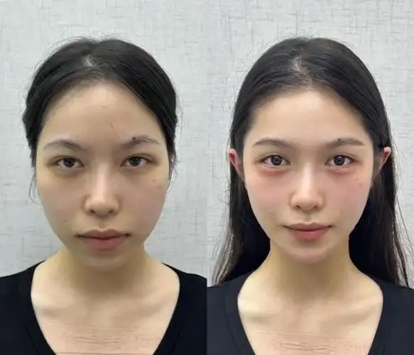 但是,你有没有发现,同样是面部填充,有些人填充后的效果就是那么出色