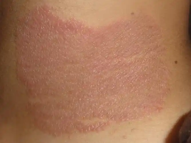 颈侧神经性皮炎 - 皮肤及性传播疾病讨论版 - 爱爱医医学论坛