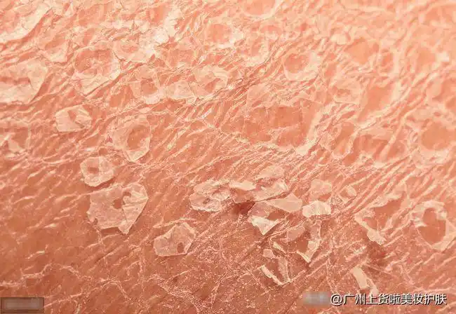 秋冬满腿全是皮屑怎么办|保湿|身体乳|角质|鳞屑_网易订阅