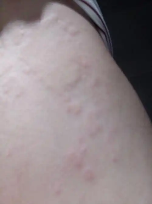 人说我是血燥热,请问怎么可以治好(发现吃了上火,鸡蛋,鱼后就会开始痒