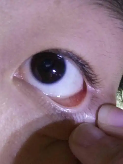 眼睛里长了两个白点,像进沙子一样,这是沙眼吗,用什么药能好啊