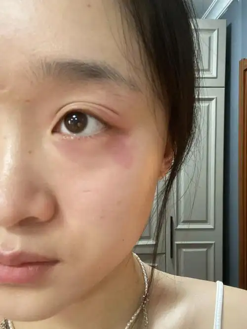 对自己的眼泪过敏重度敏感肌的痛谁懂哇01