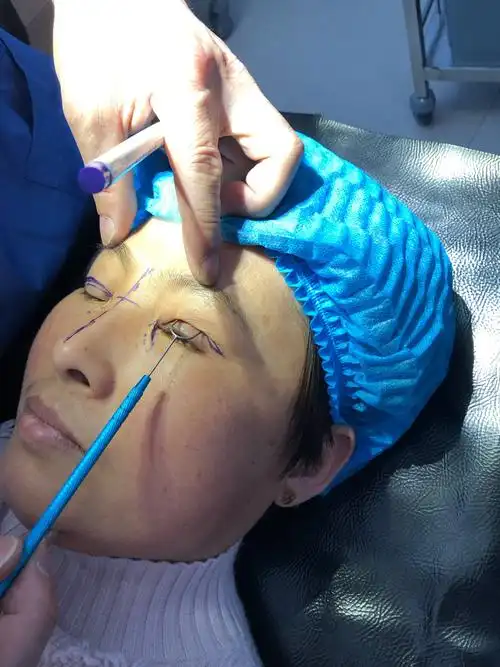 博爱医院完成两例上睑下垂手术